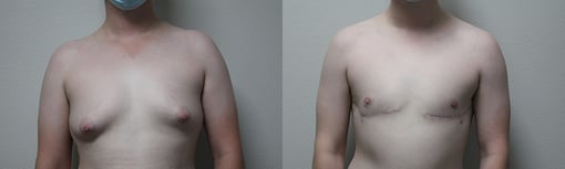 female to male transition before and after photos by kryger institute of plastic surgery in thousand oaks ca