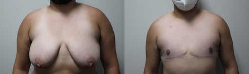 female to male transition before and after photos by kryger institute of plastic surgery in thousand oaks ca