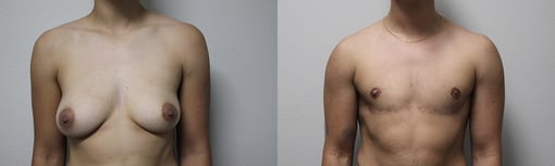female to male transition before and after photos by kryger institute of plastic surgery in thousand oaks ca