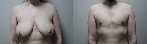 female to male transition before and after photos by kryger institute of plastic surgery in thousand oaks ca