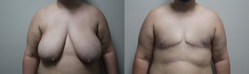 female to male transition before and after photos by kryger institute of plastic surgery in thousand oaks ca