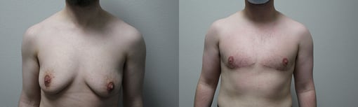 female to male transition before and after photos by kryger institute of plastic surgery in thousand oaks ca