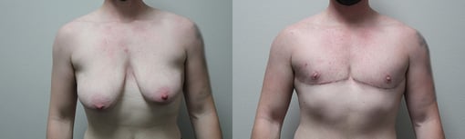 female to male transition before and after photos by kryger institute of plastic surgery in thousand oaks ca