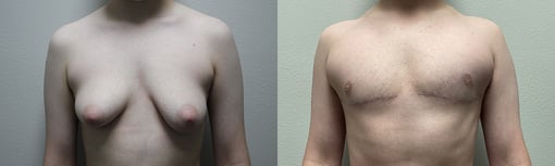 female to male transition before and after photos by kryger institute of plastic surgery in thousand oaks ca