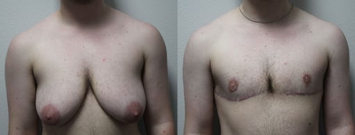 female to male transition before and after photos by kryger institute of plastic surgery in thousand oaks ca