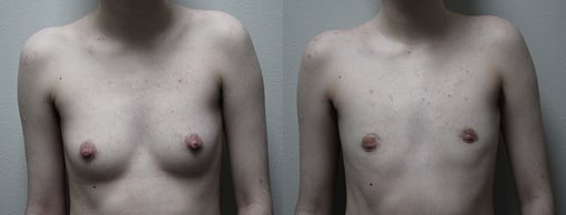 female to male transition before and after photos by kryger institute of plastic surgery in thousand oaks ca