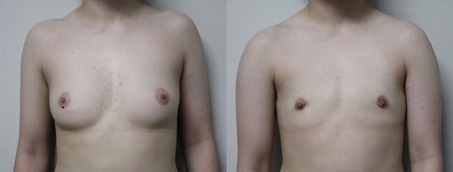 female to male transition before and after photos by kryger institute of plastic surgery in thousand oaks ca