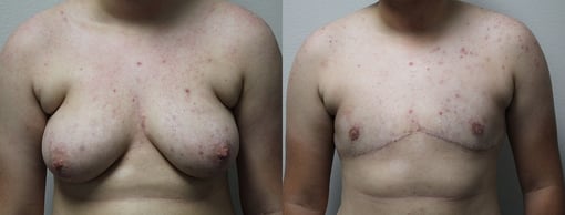 female to male transition before and after photos by kryger institute of plastic surgery in thousand oaks ca