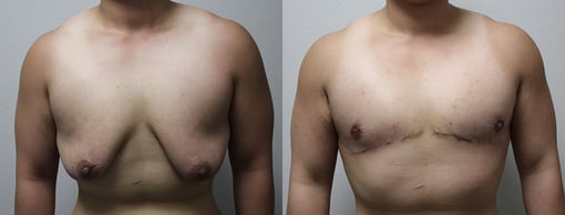 female to male transition before and after photos by kryger institute of plastic surgery in thousand oaks ca