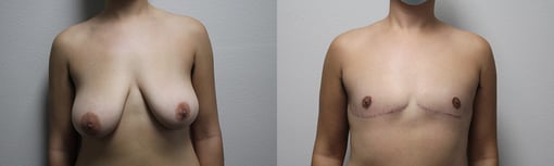 female to male transition before and after photos by kryger institute of plastic surgery in thousand oaks ca