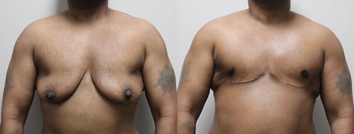 female to male transition before and after photos by kryger institute of plastic surgery in thousand oaks ca