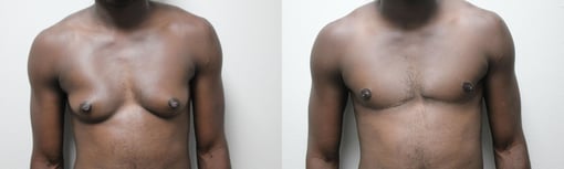 female to male transition before and after photos by kryger institute of plastic surgery in thousand oaks ca
