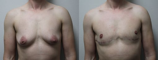 female to male transition before and after photos by kryger institute of plastic surgery in thousand oaks ca