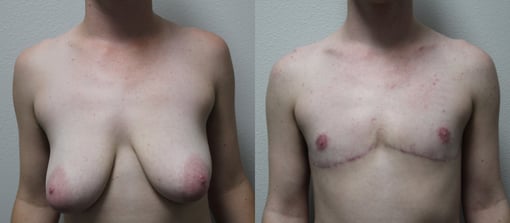 female to male transition before and after photos by kryger institute of plastic surgery in thousand oaks ca