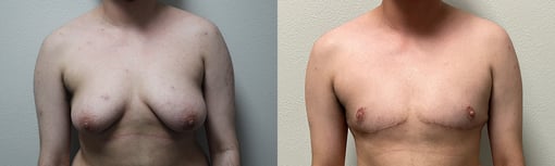 female to male transition before and after photos by kryger institute of plastic surgery in thousand oaks ca