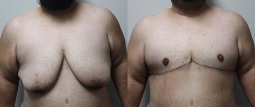 female to male transition before and after photos by kryger institute of plastic surgery in thousand oaks ca