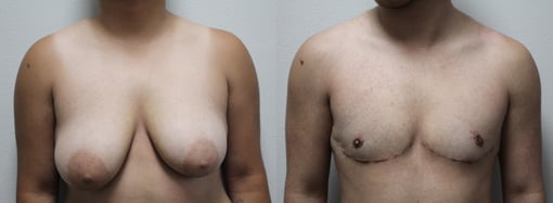female to male transition before and after photos by kryger institute of plastic surgery in thousand oaks ca