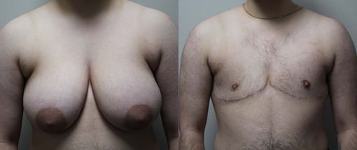 female to male transition before and after photos by kryger institute of plastic surgery in thousand oaks ca