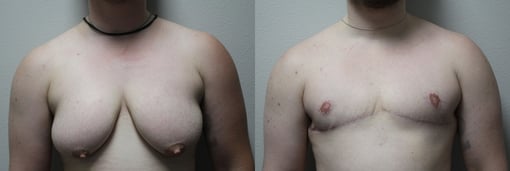 female to male transition before and after photos by kryger institute of plastic surgery in thousand oaks ca
