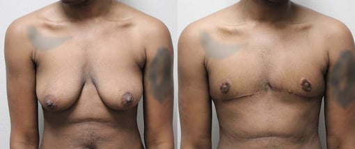 female to male transition before and after photos by kryger institute of plastic surgery in thousand oaks ca