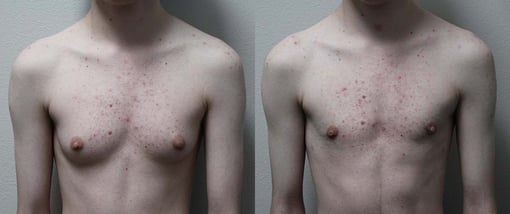 female to male transition before and after photos by kryger institute of plastic surgery in thousand oaks ca