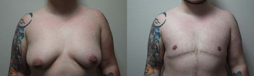 female to male transition before and after photos by kryger institute of plastic surgery in thousand oaks ca