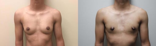 female to male transition before and after photos by kryger institute of plastic surgery in thousand oaks ca