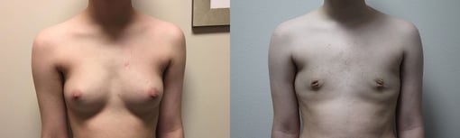 female to male transition before and after photos by kryger institute of plastic surgery in thousand oaks ca