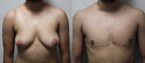 female to male transition before and after photos by kryger institute of plastic surgery in thousand oaks ca