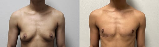 female to male transition before and after photos by kryger institute of plastic surgery in thousand oaks ca