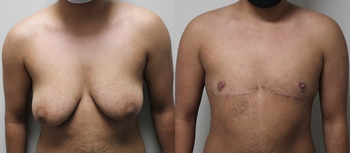 female to male transition before and after photos by kryger institute of plastic surgery in thousand oaks ca
