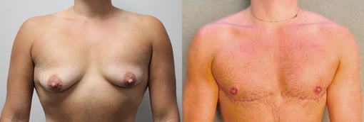 female to male transition before and after photos by kryger institute of plastic surgery in thousand oaks ca