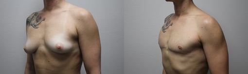 female to male transition before and after photos by kryger institute of plastic surgery in thousand oaks ca