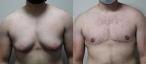 female to male transition before and after photos by kryger institute of plastic surgery in thousand oaks ca