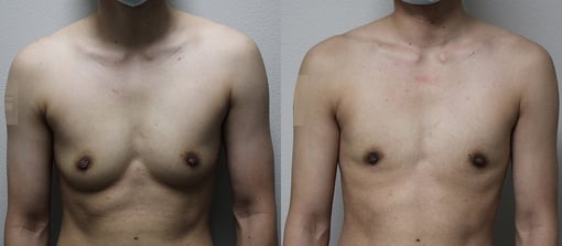 female to male transition before and after photos by kryger institute of plastic surgery in thousand oaks ca