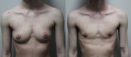 female to male transition before and after photos by kryger institute of plastic surgery in thousand oaks ca