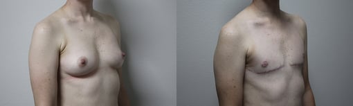 female to male transition before and after photos by kryger institute of plastic surgery in thousand oaks ca