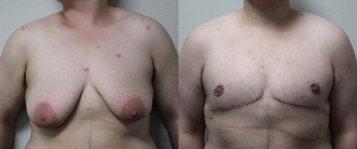 female to male transition before and after photos by kryger institute of plastic surgery in thousand oaks ca