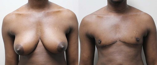 female to male transition before and after photos by kryger institute of plastic surgery in thousand oaks ca