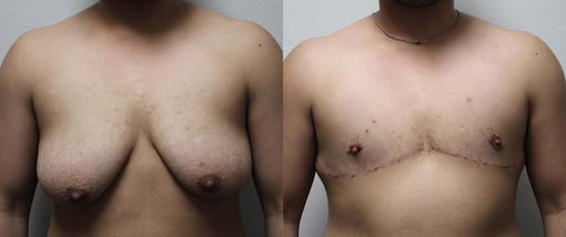 female to male transition before and after photos by kryger institute of plastic surgery in thousand oaks ca