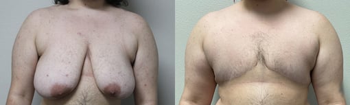 female to male transition before and after photos by kryger institute of plastic surgery in thousand oaks ca
