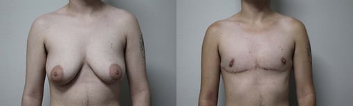 female to male transition before and after photos by kryger institute of plastic surgery in thousand oaks ca