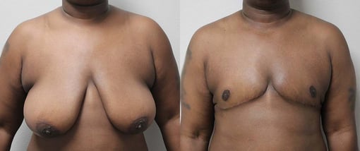 female to male transition before and after photos by kryger institute of plastic surgery in thousand oaks ca