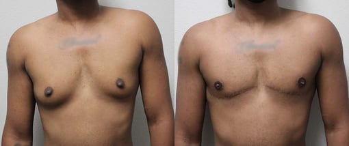female to male transition before and after photos by kryger institute of plastic surgery in thousand oaks ca