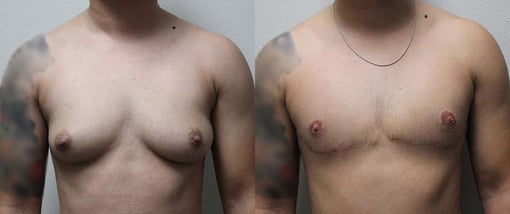 female to male transition before and after photos by kryger institute of plastic surgery in thousand oaks ca