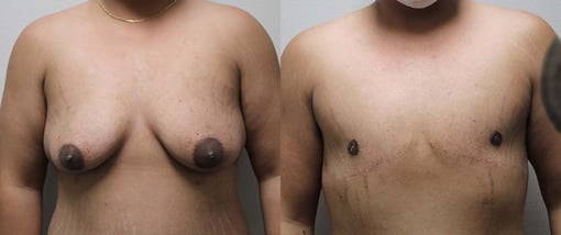 female to male transition before and after photos by kryger institute of plastic surgery in thousand oaks ca