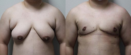 female to male transition before and after photos by kryger institute of plastic surgery in thousand oaks ca