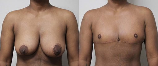 female to male transition before and after photos by kryger institute of plastic surgery in thousand oaks ca