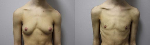 female to male transition before and after photos by kryger institute of plastic surgery in thousand oaks ca