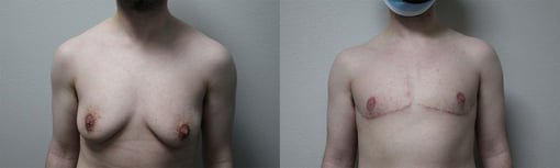 female to male transition before and after photos by kryger institute of plastic surgery in thousand oaks ca